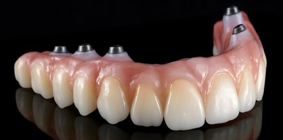 dental implants
