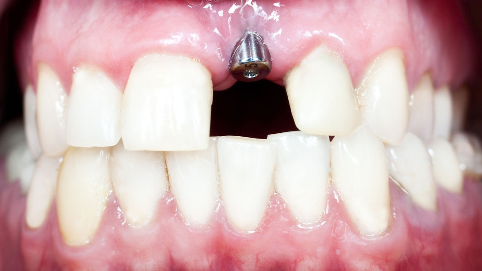 Close-up of a person's teeth with a dental implant in the gums. Pink gums contrast with the white teeth. No background details.