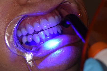 WANT A BRIGHTER SMILE? HERE'S WHAT TO KNOW BEFORE WHITENING YOUR TEETH