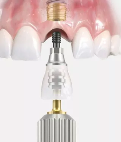 how_dental_implant_look_like