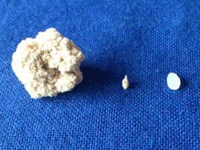 鍼灸で逆子治療？