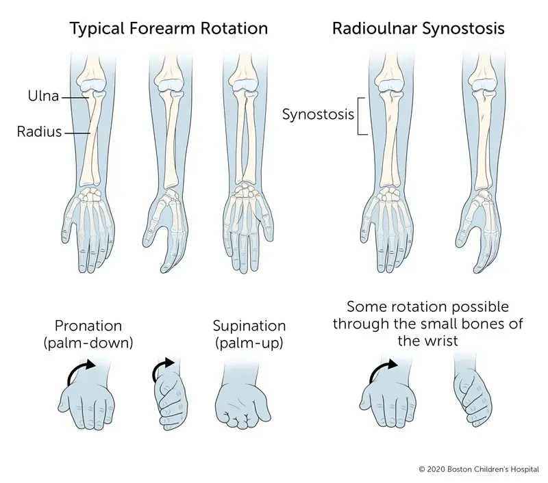 Diagram of typical forearm rotation vs Radioulnar Synostosis rotation