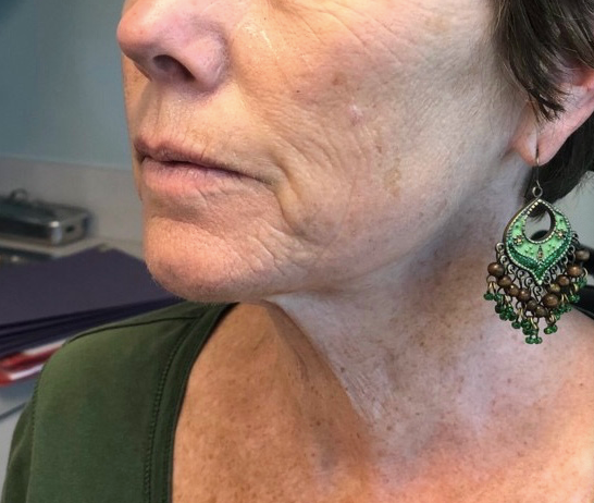 Before: Lower Face