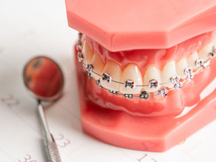 Elástico intermaxilar en Brackets