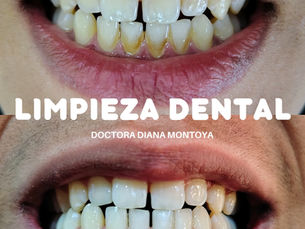 Antes y después de limpieza dental