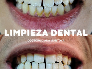 Antes y después de limpieza dental