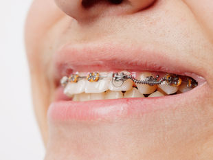 Brackets metalicos