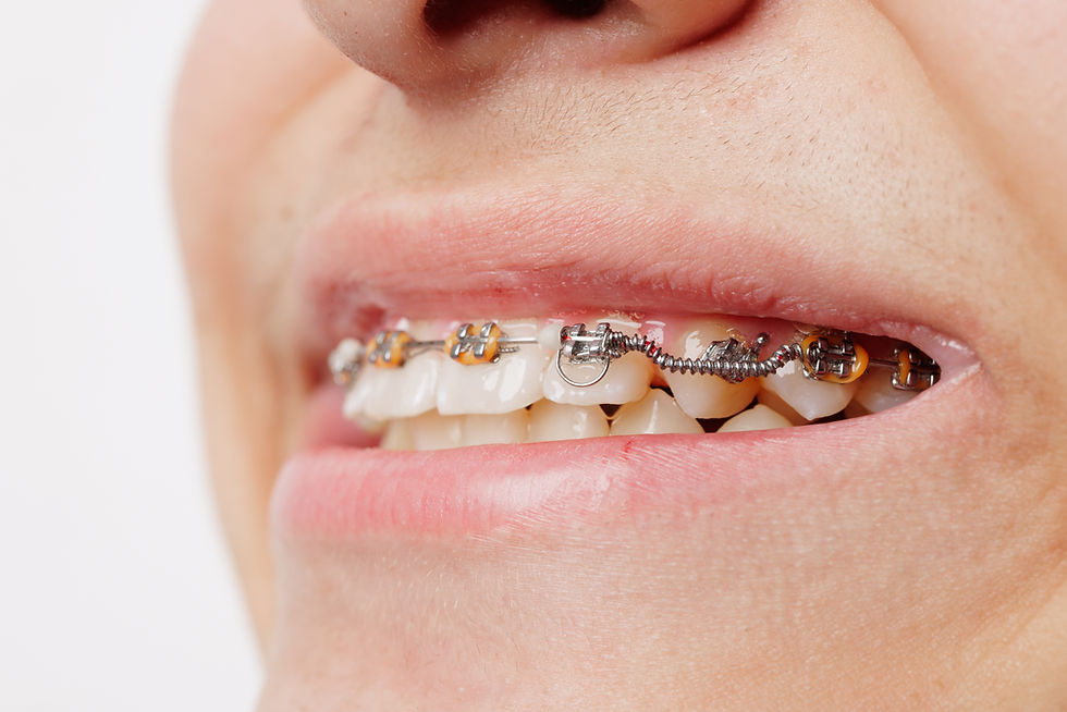 Dientes en mal estado, caries, rotos, sangrado de encías