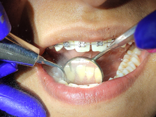 Limpieza dental con brackets