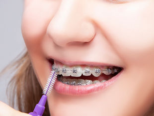 Higiene con brackets