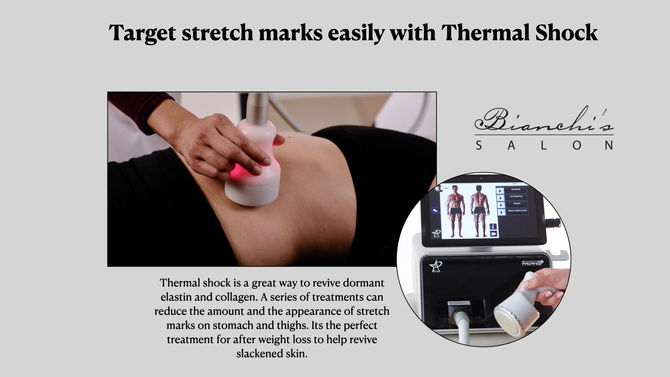 Transform Your Skin: Target Stretch Marks Effectively with Star T-Shock