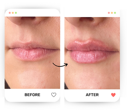 Lip Filler Sunderland