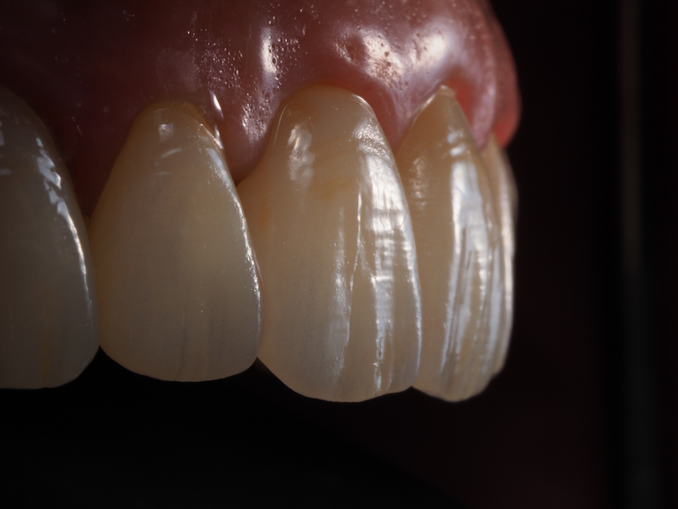 Fixed Finals Absolute Dental Lab