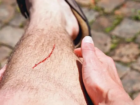 How Does My Wound Heal, and How Do I Treat It?