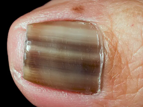 Unexpected Places You Can Get Skin Cancer