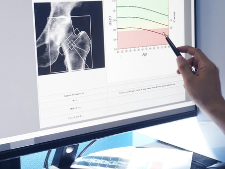 How Do I Increase Bone Density After 60?