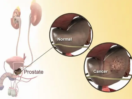 Slideshow: A Visual Guide to Prostate Cancer
