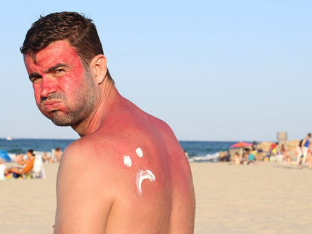 Sun poisoning symptoms: Signs you've had too much sun