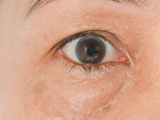 What Your Puffy Eyes Are Trying to Tell You