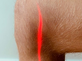 Laserbehandling er en smertefri behandlingsmåte som er effektiv på redusere smerte