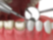 When-Do-You-Need-a-Deep-Teeth-Cleaning-vs.-a-Regular-Cleaning.jpeg