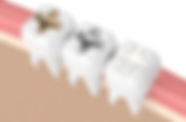 White fillings orlando.jpeg