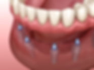 Orlando Implant Denture.jpeg