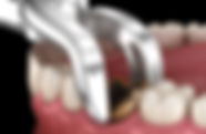 orland tooth extraction.jpeg