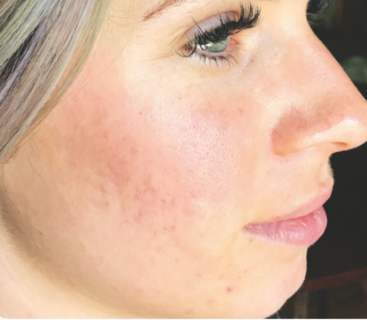 reduced wrinkles - Premier Image