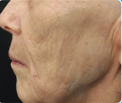 Skin Rejuvenation - Premier Image