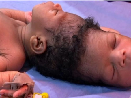 Conjoined twins separated with help of AI