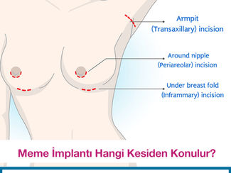 Meme Büyütmede kullanılan kesiler