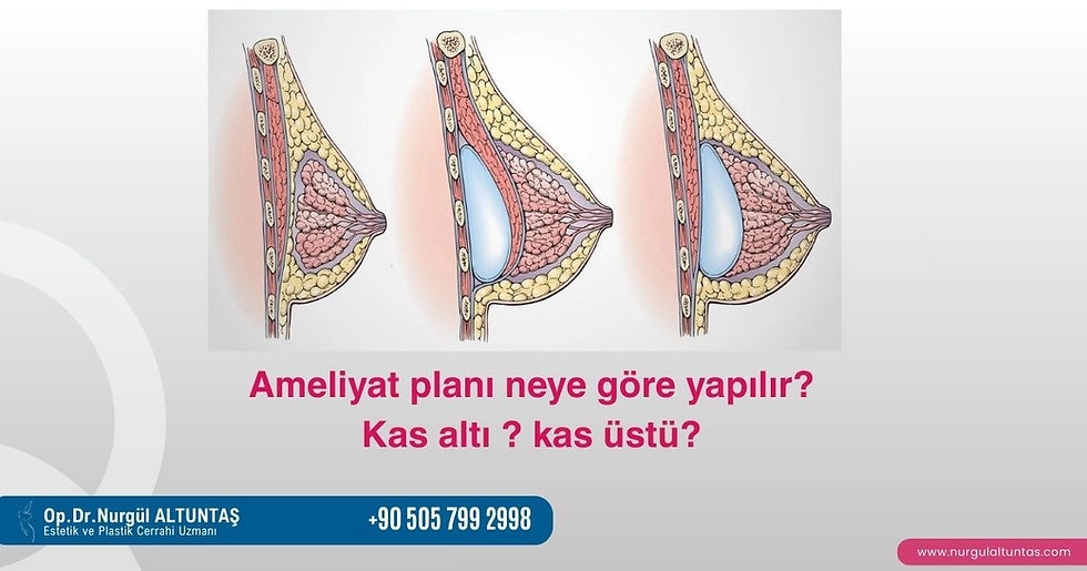 meme implantı kas altı kas üstü yerleşim