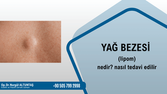 YAĞ BEZESİ (LİPOM) NEDİR