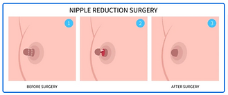 nipple küçültme