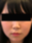 HP用 カベリン目隠し 施術後目隠し改.jpg