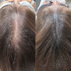 Hair Growth & Trichology Treatments in Haywards Heath