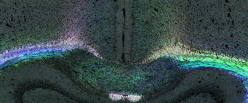 Demyelination of corpus callosum