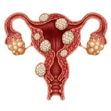 Cirurgias Ginecologicas Gineco Imagem