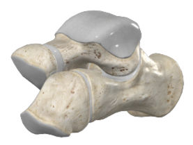 Spiralling together: Into the Calcaneus