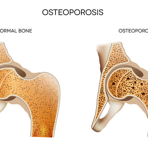 Is Osteoporosis Under-diagnosed in Men?