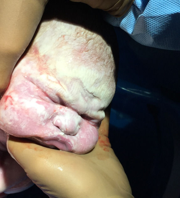 Baby Being Born | Vernix Caseosa at birth