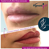removal_of_dark_deep_lip_pigmentation_3_sessions_with_pigmentoff_2_20180427_1734609835.jpg