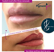 removal_of_dark_deep_lip_pigmentation_3_sessions_with_pigmentoff_2_20180427_1734609835.jpg