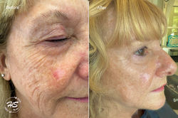 COLD PLASMA AND PROCELL THERAPY
