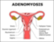 1-adenomyosisc.jpg