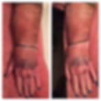Edema before & after