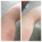 *Ezcema before/after