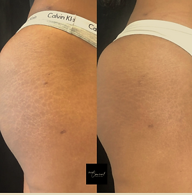 Before and After of stretch marks disappearing on a woman's booty
