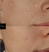 Before and After Inkless Tattoo for Acne Scars
